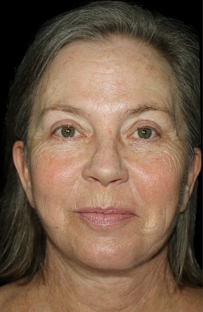 Blepharoplasty Before & After Gallery - Patient 401672 - Image 2