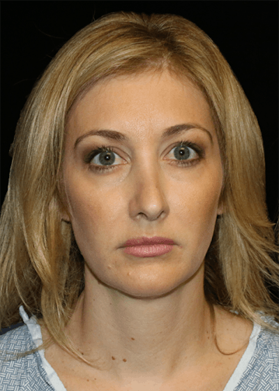 Blepharoplasty Before & After Gallery - Patient 304086 - Image 1