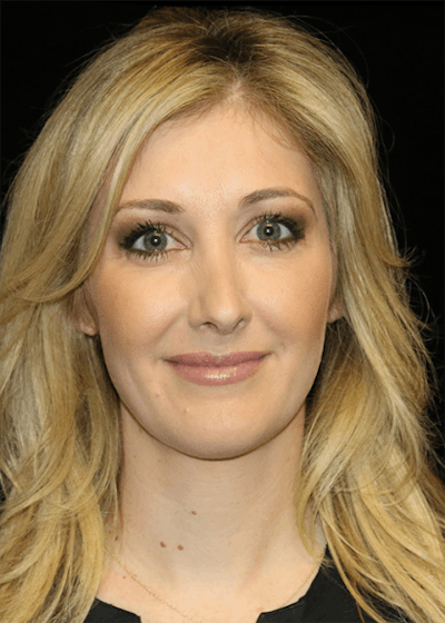 Blepharoplasty Before & After Gallery - Patient 304086 - Image 2