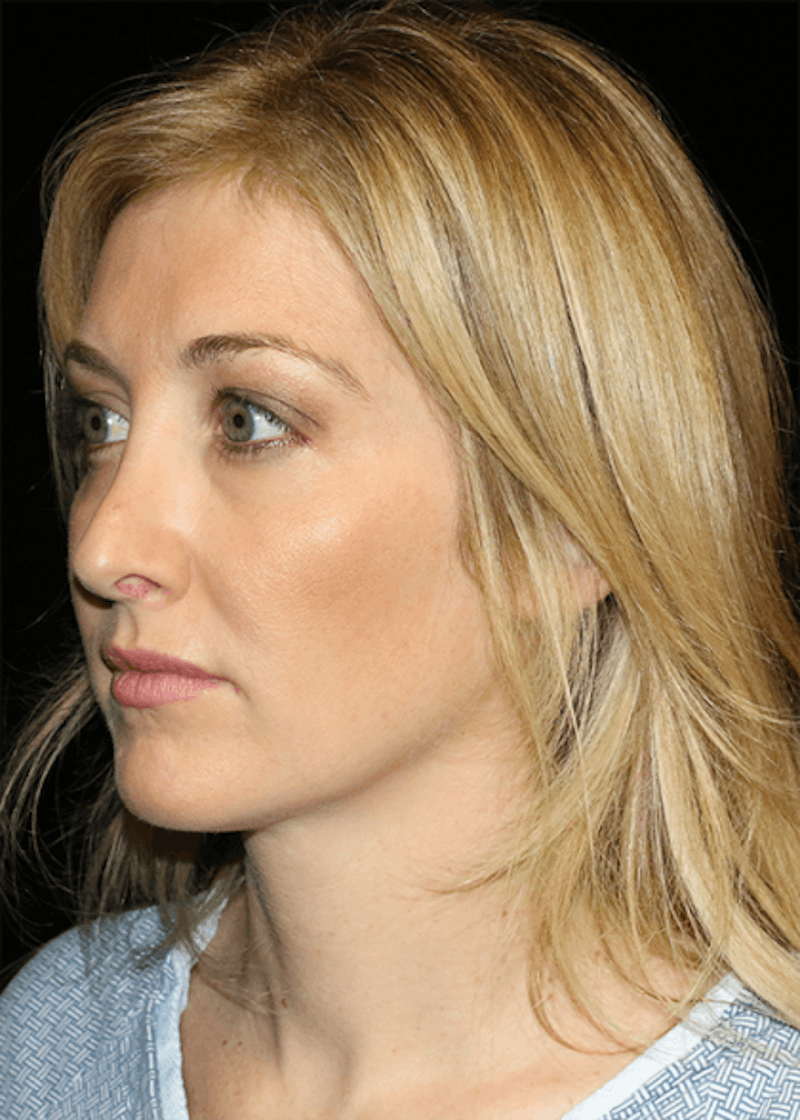 Blepharoplasty Before & After Gallery - Patient 304086 - Image 3