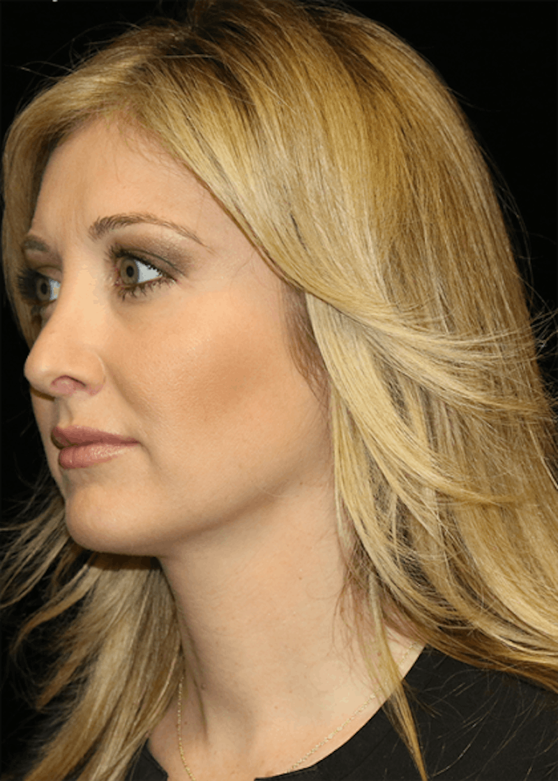 Blepharoplasty Before & After Gallery - Patient 304086 - Image 4