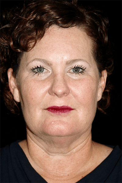 Blepharoplasty Before & After Gallery - Patient 376580 - Image 1
