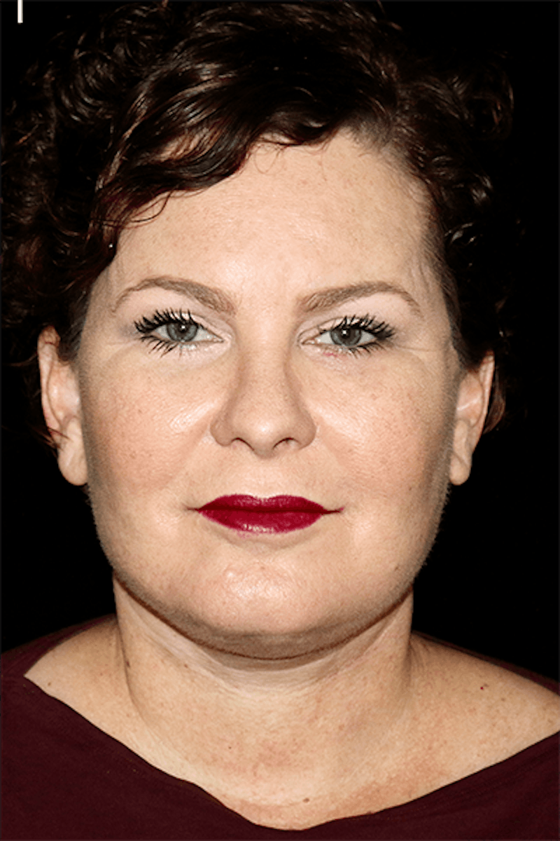 Blepharoplasty Before & After Gallery - Patient 376580 - Image 2
