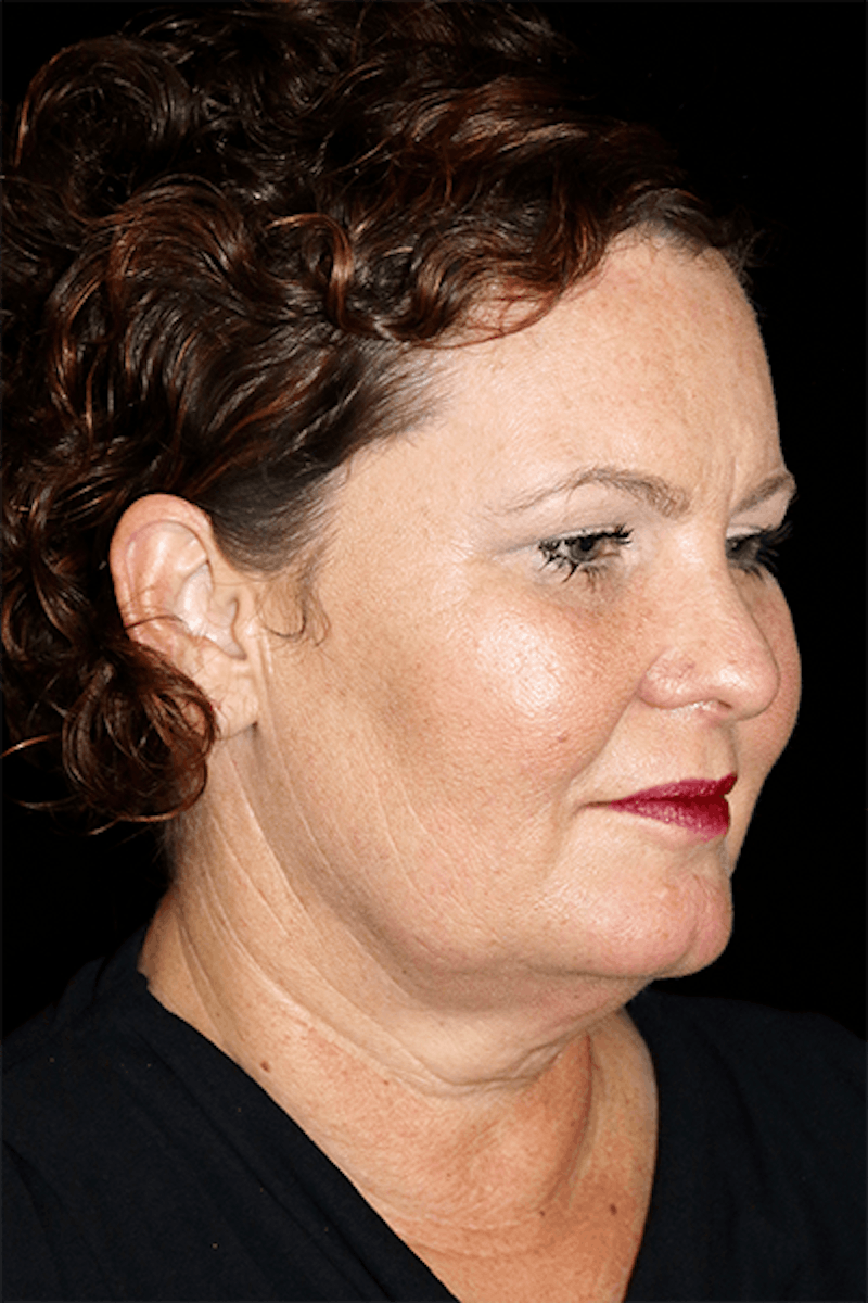 Blepharoplasty Before & After Gallery - Patient 376580 - Image 3