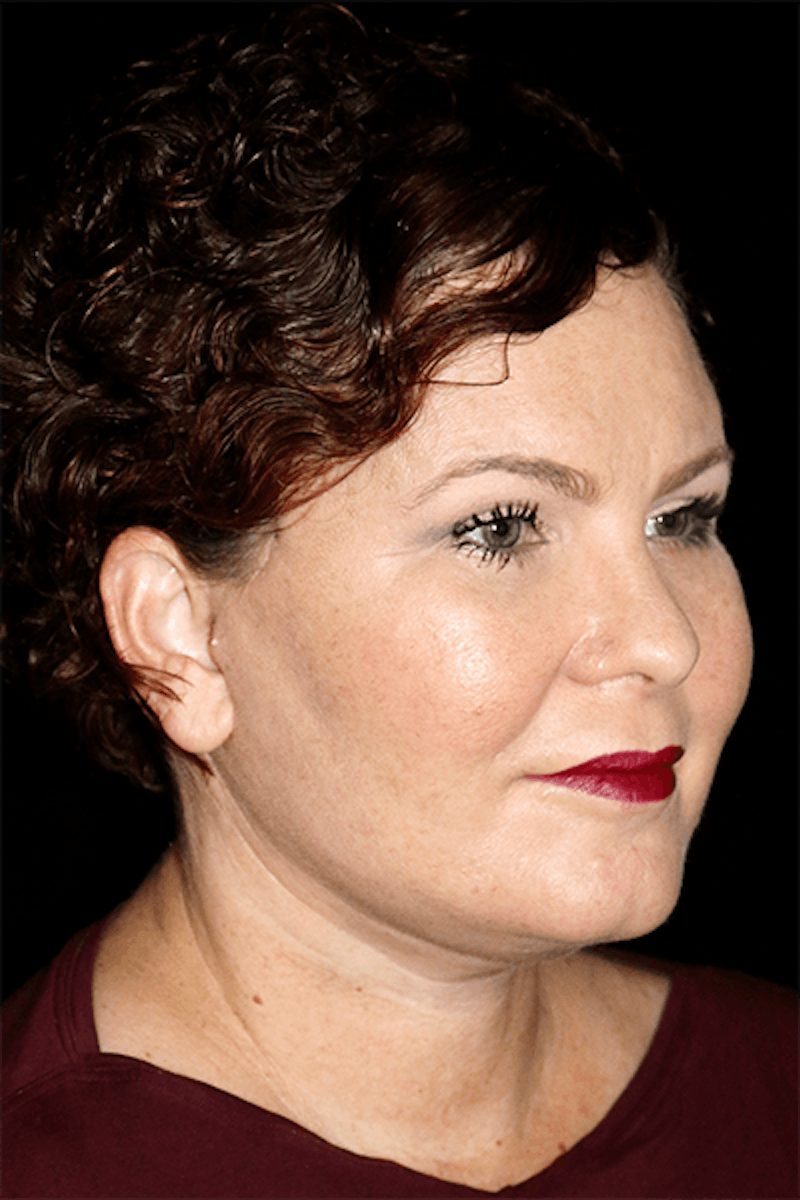 Blepharoplasty Before & After Gallery - Patient 376580 - Image 4
