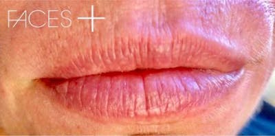Lip Filler Before & After Gallery - Patient 334789 - Image 1