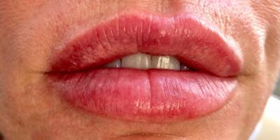 Lip Filler Before & After Gallery - Patient 334789 - Image 2
