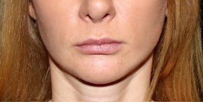 Lip Filler Before & After Gallery - Patient 407949 - Image 1