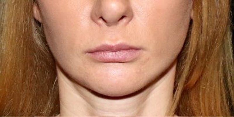 Lip Filler Before & After Gallery - Patient 407949 - Image 1