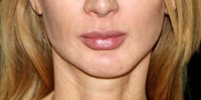 Lip Filler Before & After Gallery - Patient 407949 - Image 2