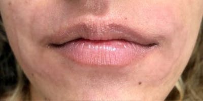Lip Filler Before & After Gallery - Patient 905912 - Image 1