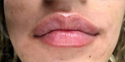 Lip Filler Before & After Gallery - Patient 905912 - Image 2