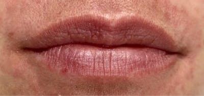 Lip Filler Before & After Gallery - Patient 998489 - Image 1