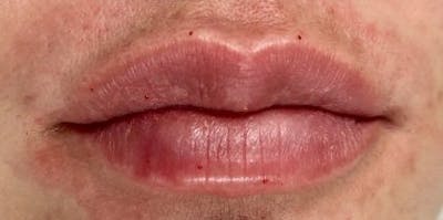 Lip Filler Before & After Gallery - Patient 998489 - Image 2
