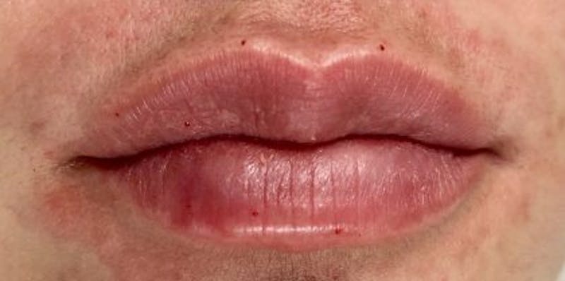Lip Filler Before & After Gallery - Patient 998489 - Image 2