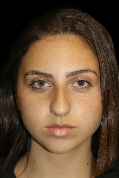 Primary Rhinoplasty Before & After Gallery - Patient 398194 - Image 1