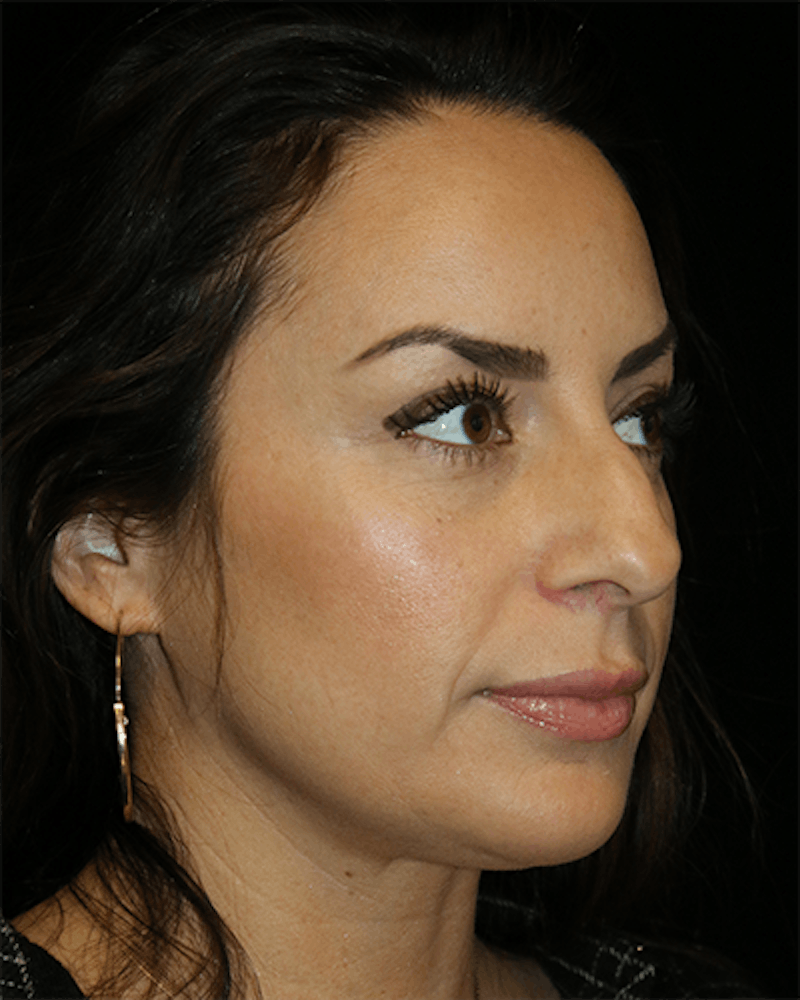 Primary Rhinoplasty Before & After Gallery - Patient 200564 - Image 3