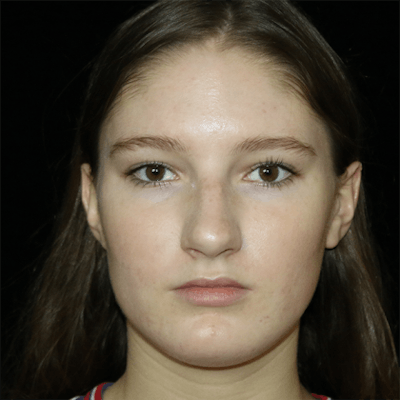 Primary Rhinoplasty Before & After Gallery - Patient 167103 - Image 1