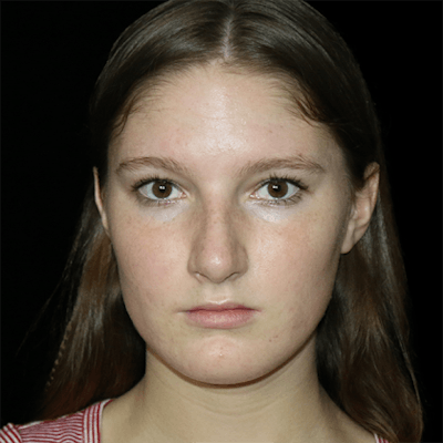 Primary Rhinoplasty Before & After Gallery - Patient 167103 - Image 2