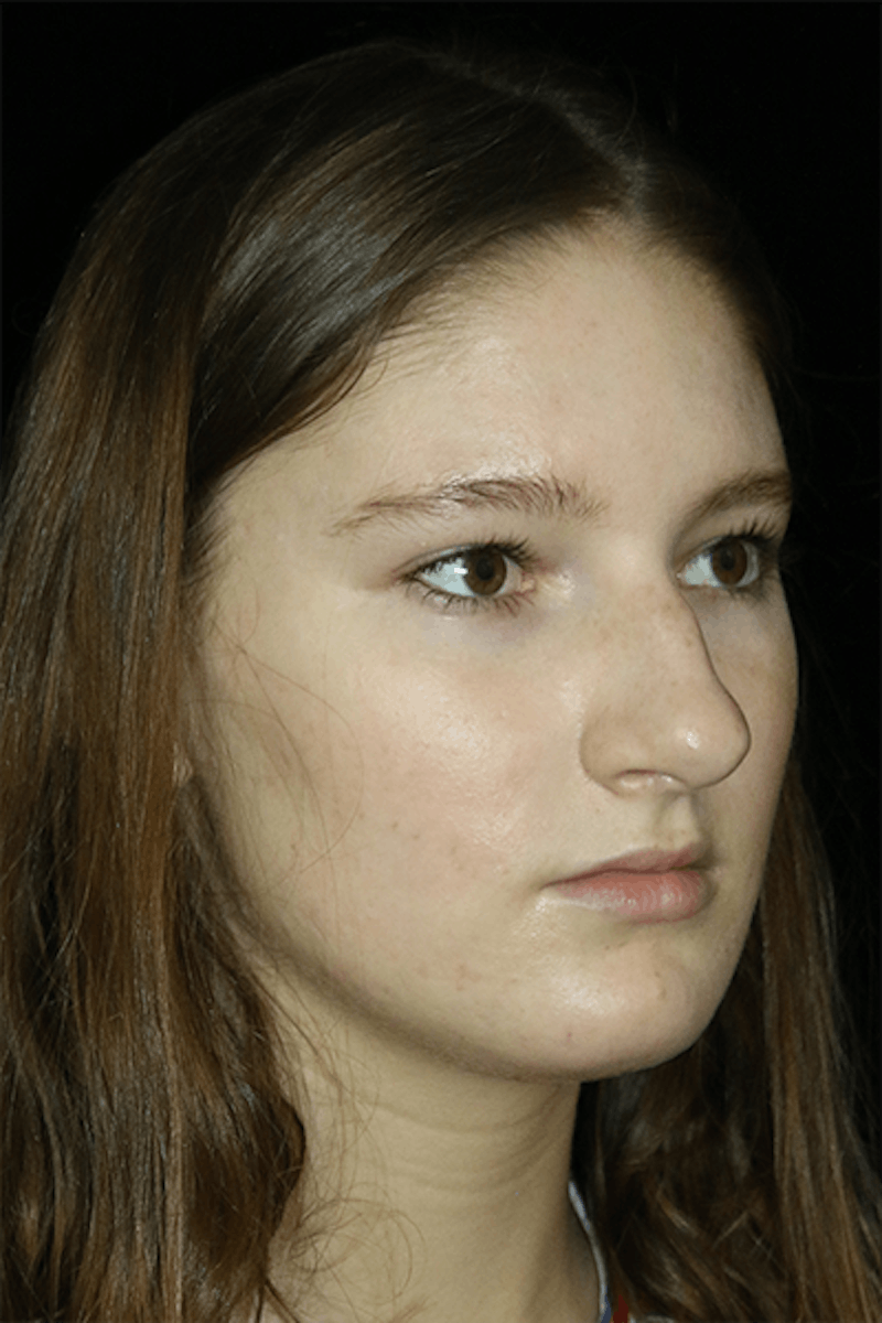 Primary Rhinoplasty Before & After Gallery - Patient 167103 - Image 3