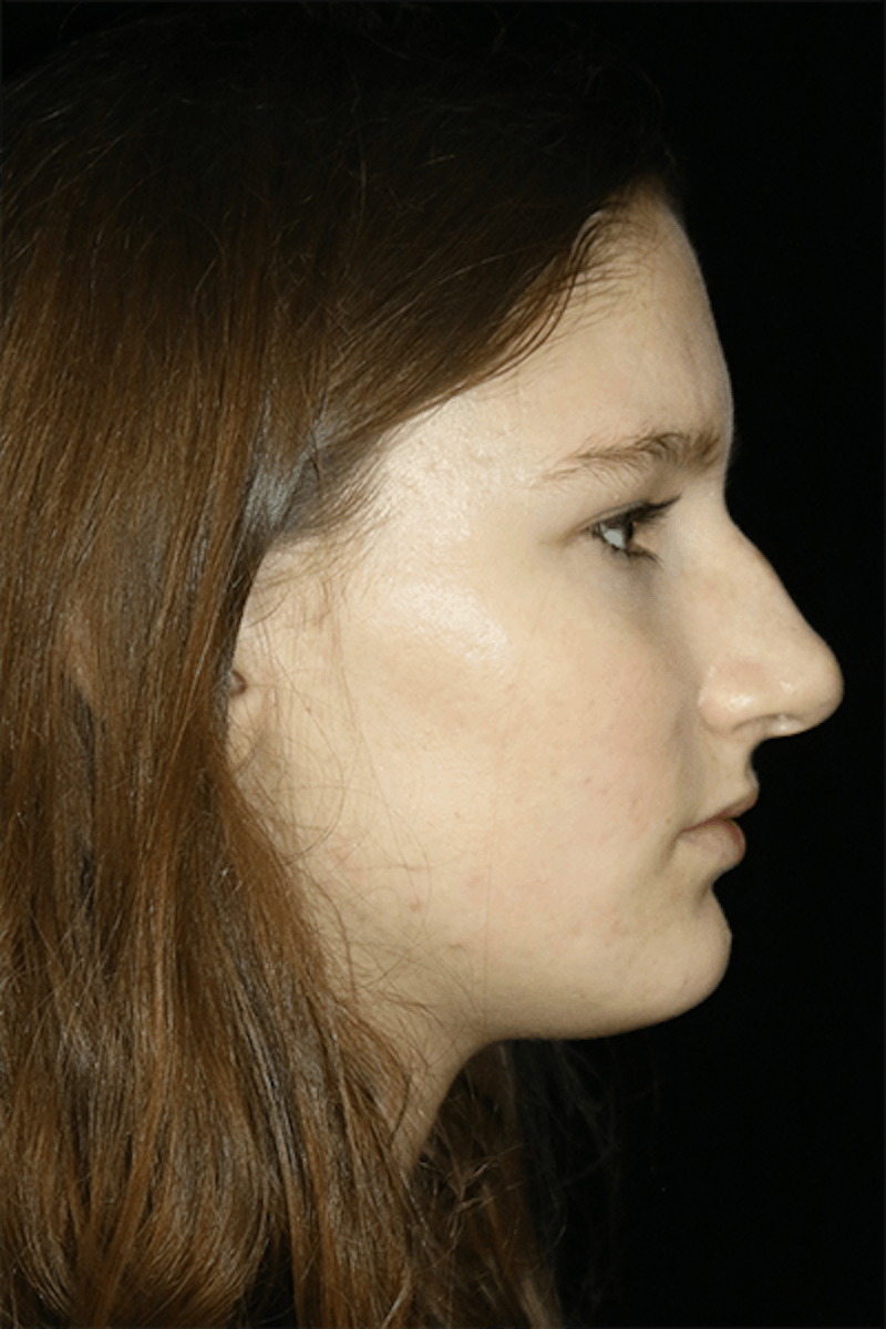 Primary Rhinoplasty Before & After Gallery - Patient 167103 - Image 5