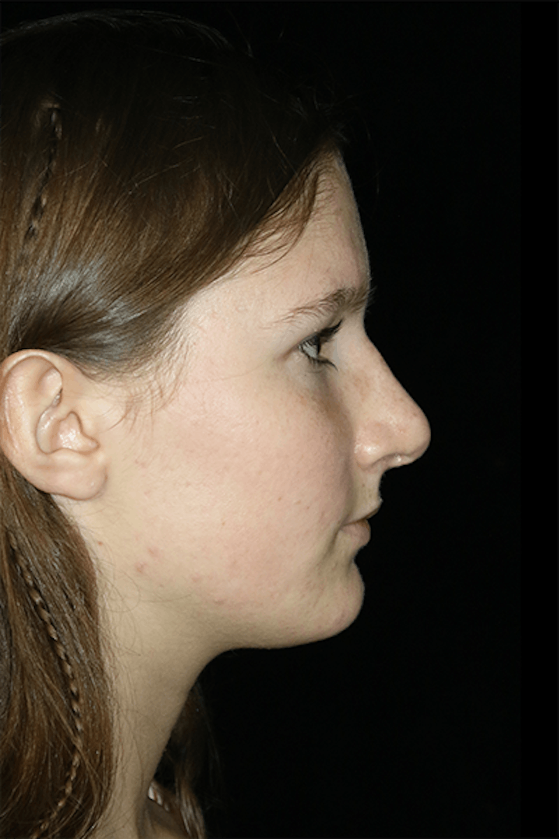 Primary Rhinoplasty Before & After Gallery - Patient 167103 - Image 6