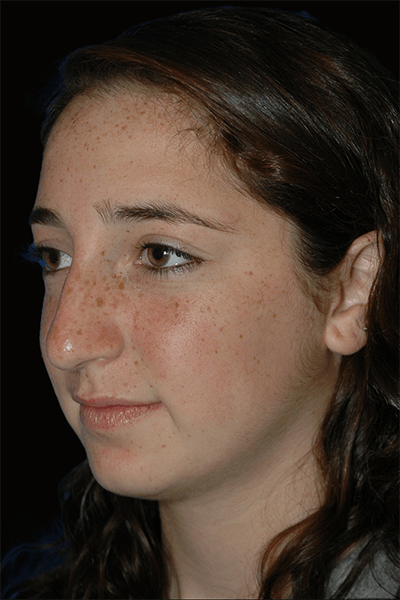 Primary Rhinoplasty Before & After Gallery - Patient 184362 - Image 1