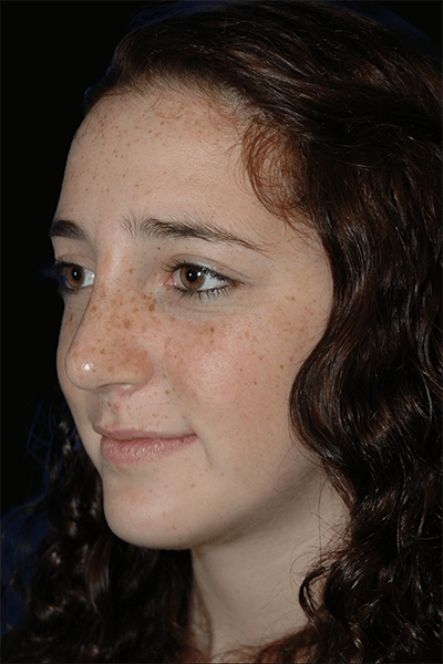 Primary Rhinoplasty Before & After Gallery - Patient 184362 - Image 2