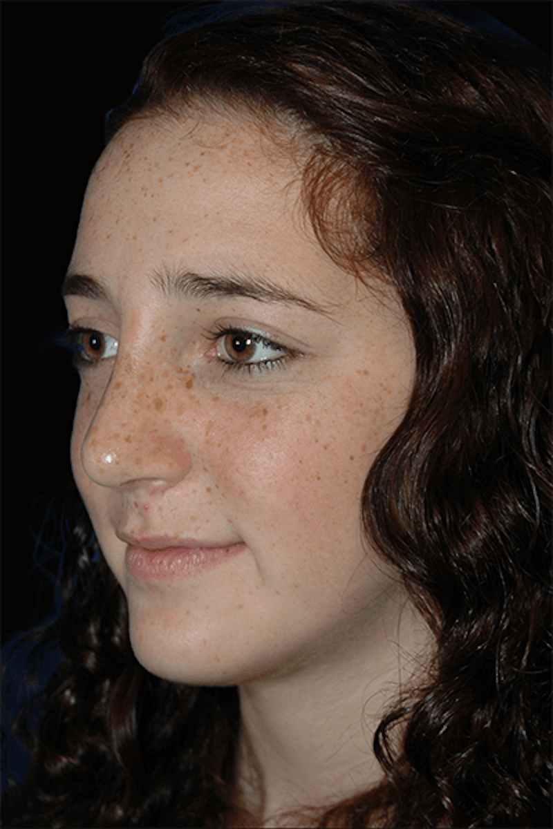 Primary Rhinoplasty Before & After Gallery - Patient 184362 - Image 2
