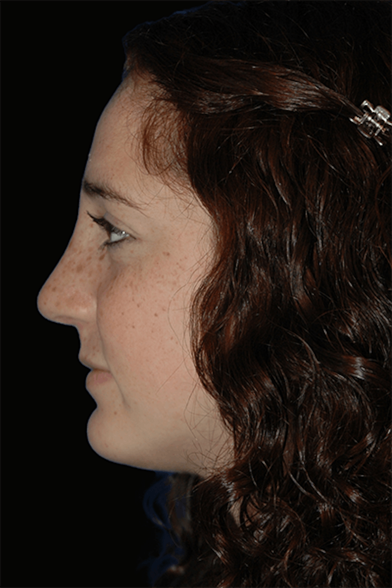 Primary Rhinoplasty Before & After Gallery - Patient 184362 - Image 4
