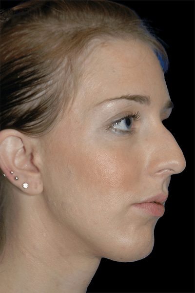 Primary Rhinoplasty Before & After Gallery - Patient 120855 - Image 1