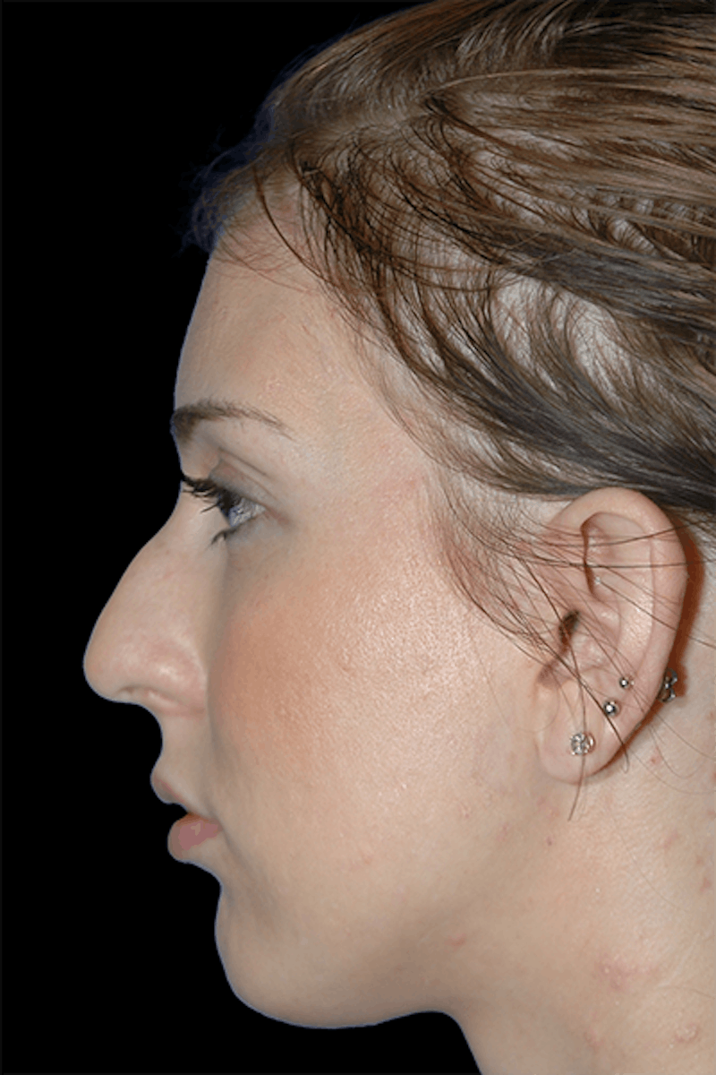 Primary Rhinoplasty Before & After Gallery - Patient 120855 - Image 3