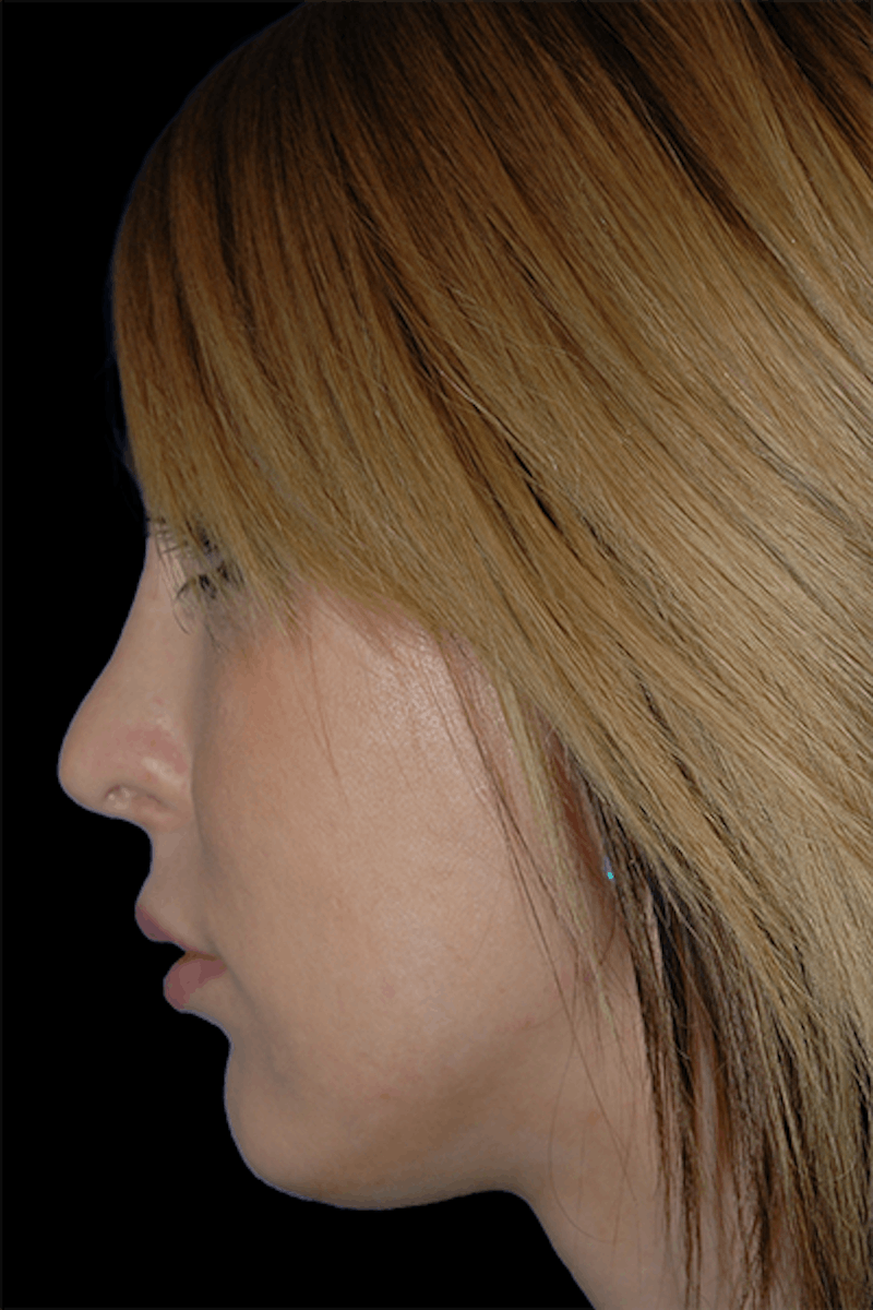 Primary Rhinoplasty Before & After Gallery - Patient 120855 - Image 4