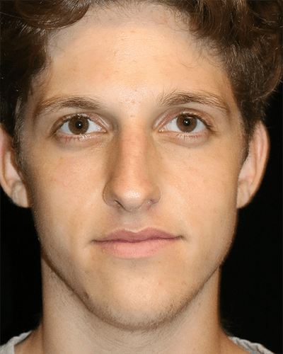 Primary Rhinoplasty Before & After Gallery - Patient 395801 - Image 1