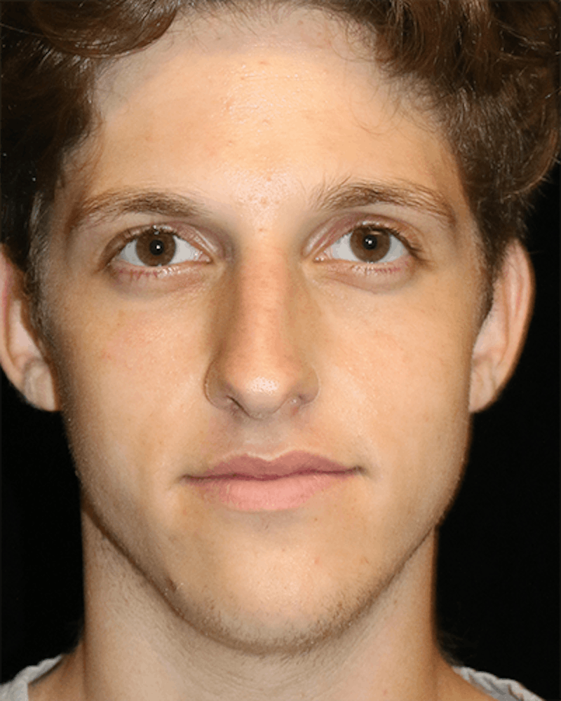 Primary Rhinoplasty Before & After Gallery - Patient 395801 - Image 1