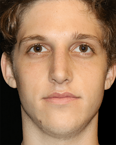 Primary Rhinoplasty Before & After Gallery - Patient 395801 - Image 2