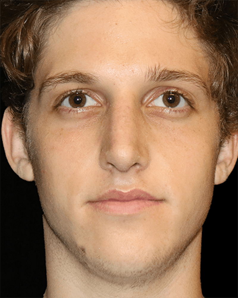Primary Rhinoplasty Before & After Gallery - Patient 395801 - Image 2