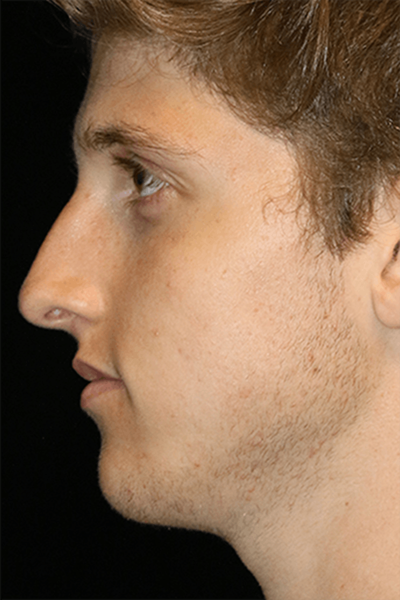Primary Rhinoplasty Before & After Gallery - Patient 395801 - Image 3
