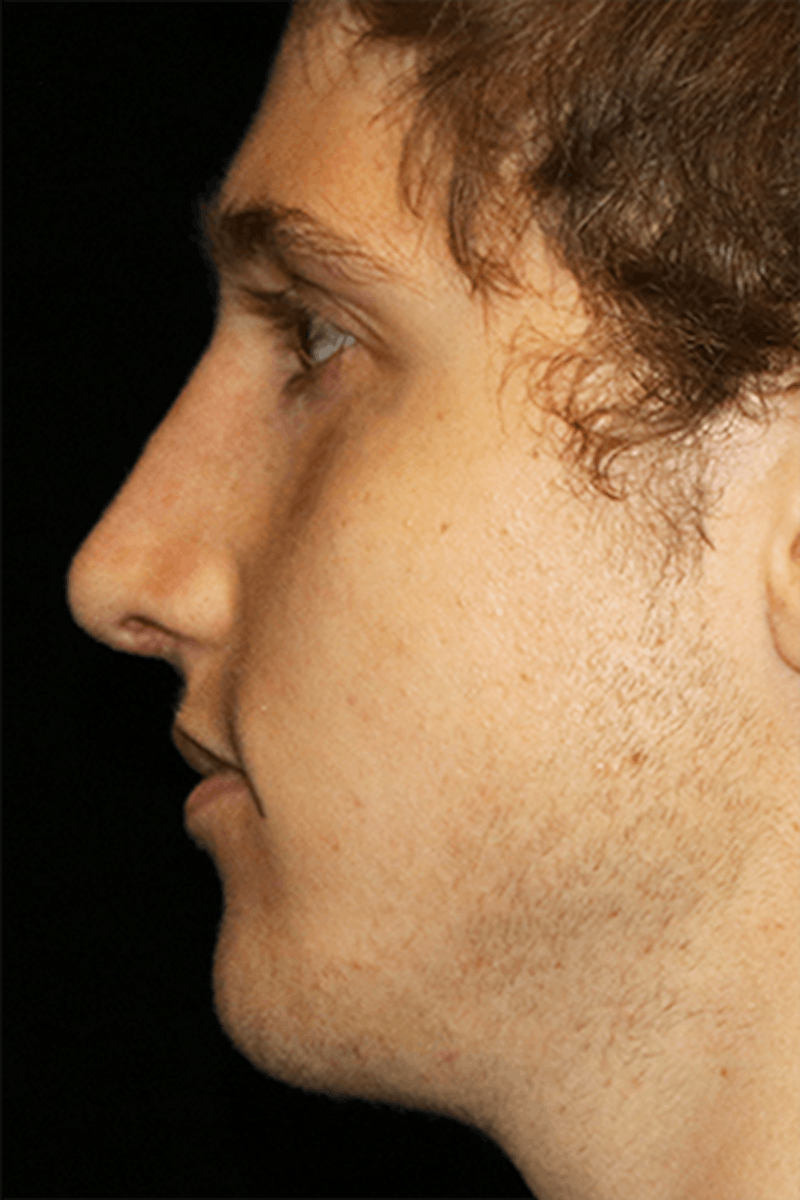 Primary Rhinoplasty Before & After Gallery - Patient 395801 - Image 4