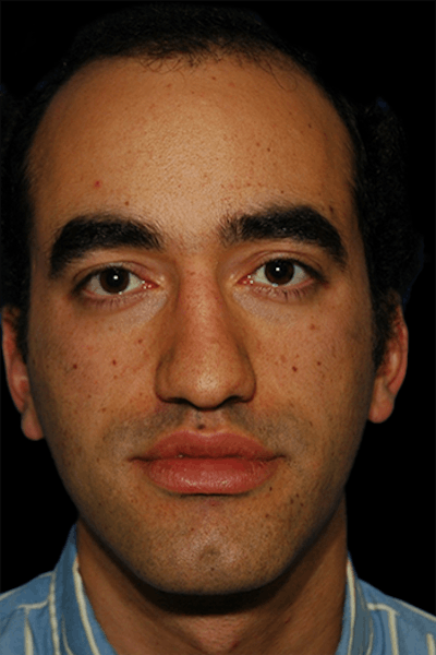 Primary Rhinoplasty Before & After Gallery - Patient 175181 - Image 1