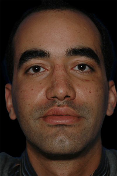 Primary Rhinoplasty Before & After Gallery - Patient 175181 - Image 2