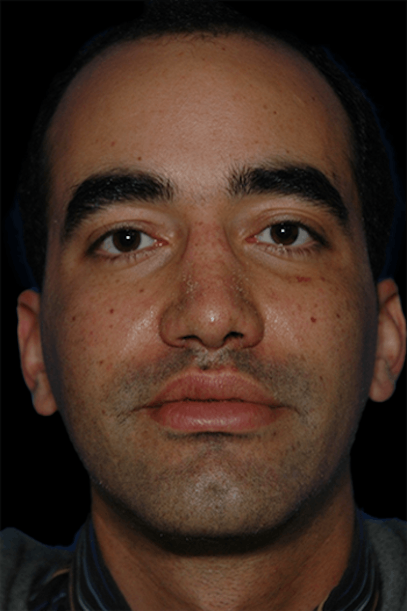 Primary Rhinoplasty Before & After Gallery - Patient 175181 - Image 2
