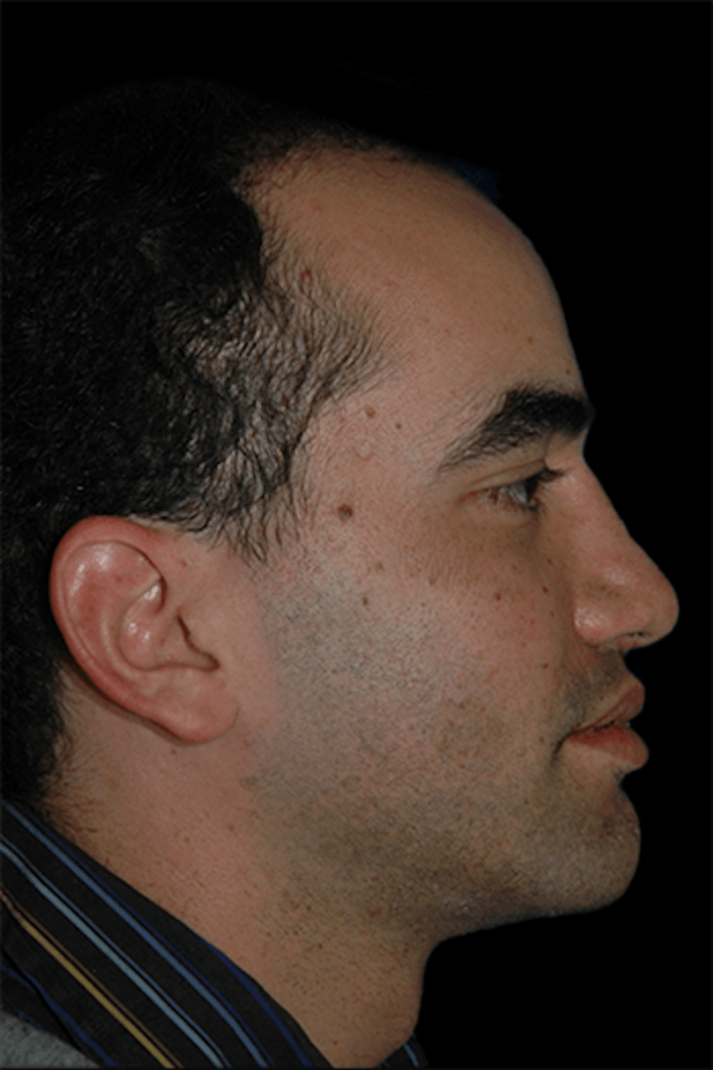 Primary Rhinoplasty Before & After Gallery - Patient 175181 - Image 4