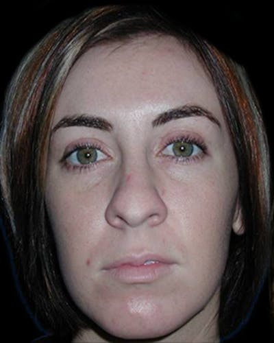 Primary Rhinoplasty Before & After Gallery - Patient 880592 - Image 1