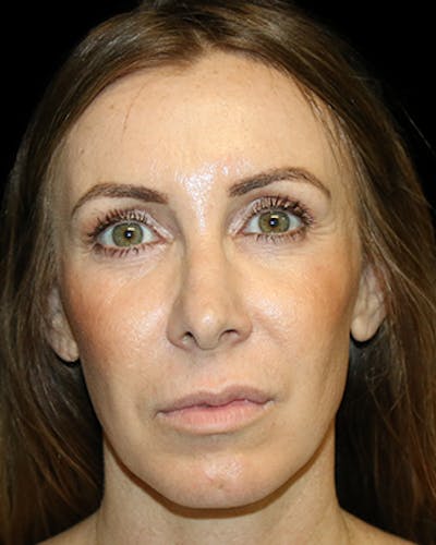 Primary Rhinoplasty Before & After Gallery - Patient 880592 - Image 2
