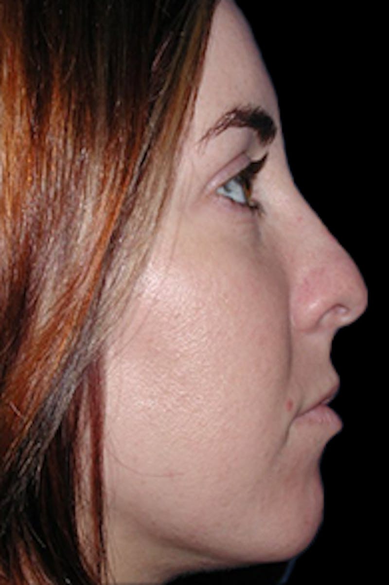 Primary Rhinoplasty Before & After Gallery - Patient 880592 - Image 3