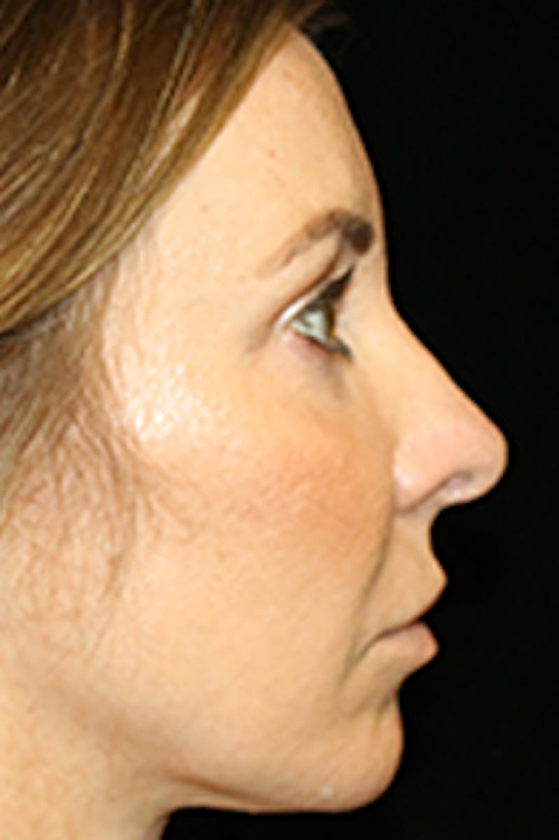 Primary Rhinoplasty Before & After Gallery - Patient 880592 - Image 4