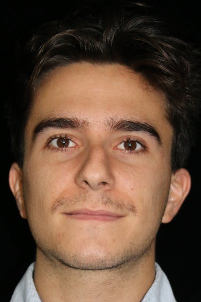 Primary Rhinoplasty Before & After Gallery - Patient 399055 - Image 1