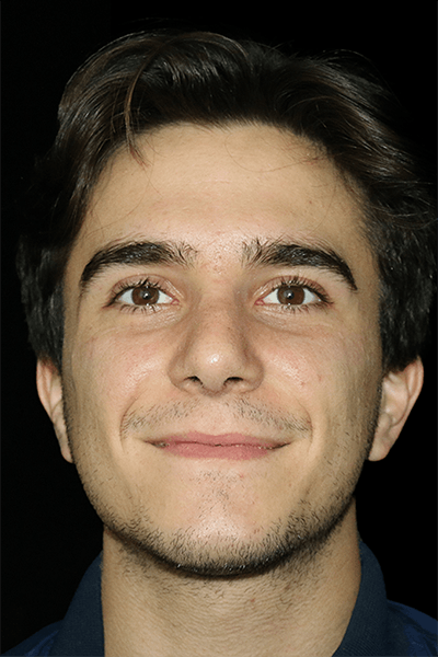 Primary Rhinoplasty Before & After Gallery - Patient 399055 - Image 2