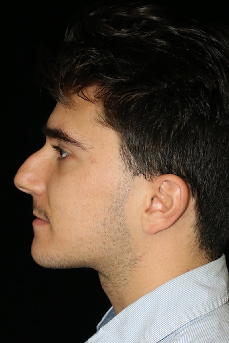 Primary Rhinoplasty Before & After Gallery - Patient 399055 - Image 3